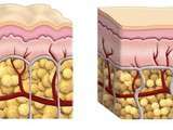 Lutter naturellement contre la cellulite